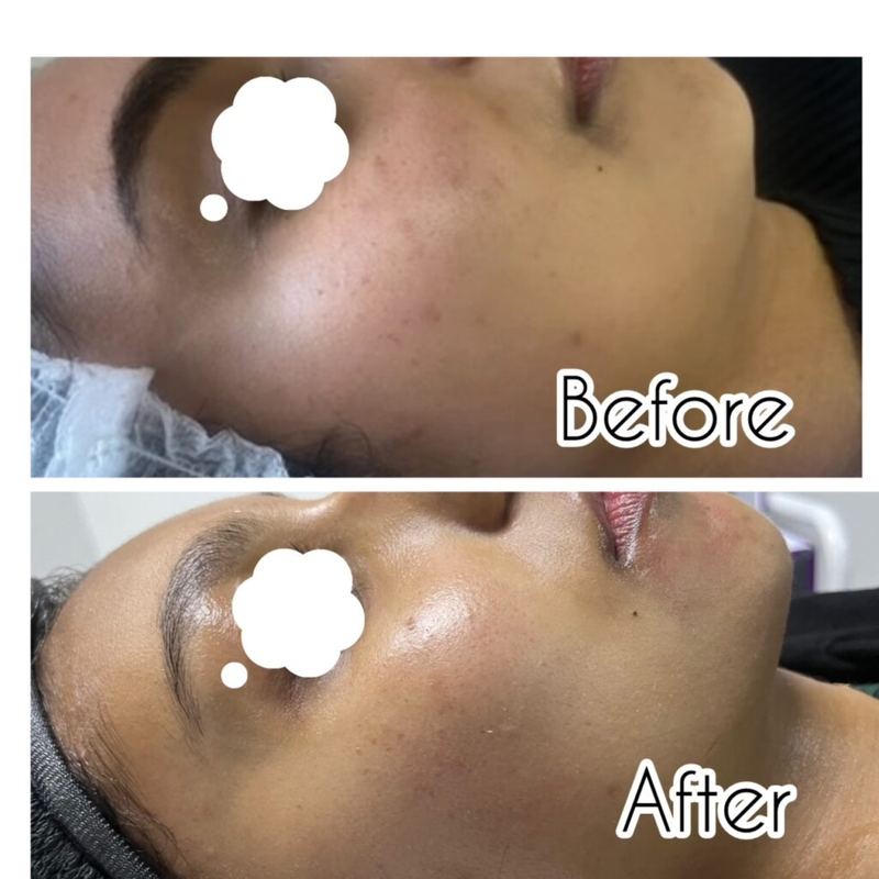 Before and after: acne